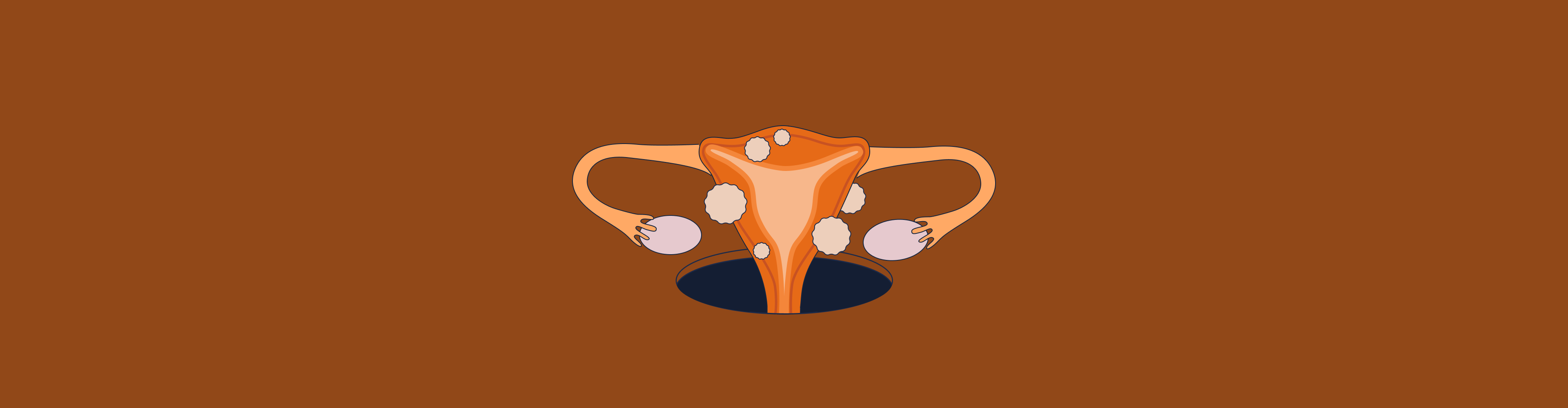 Uterine Fibroids: Causes, Symptoms, and Treatment