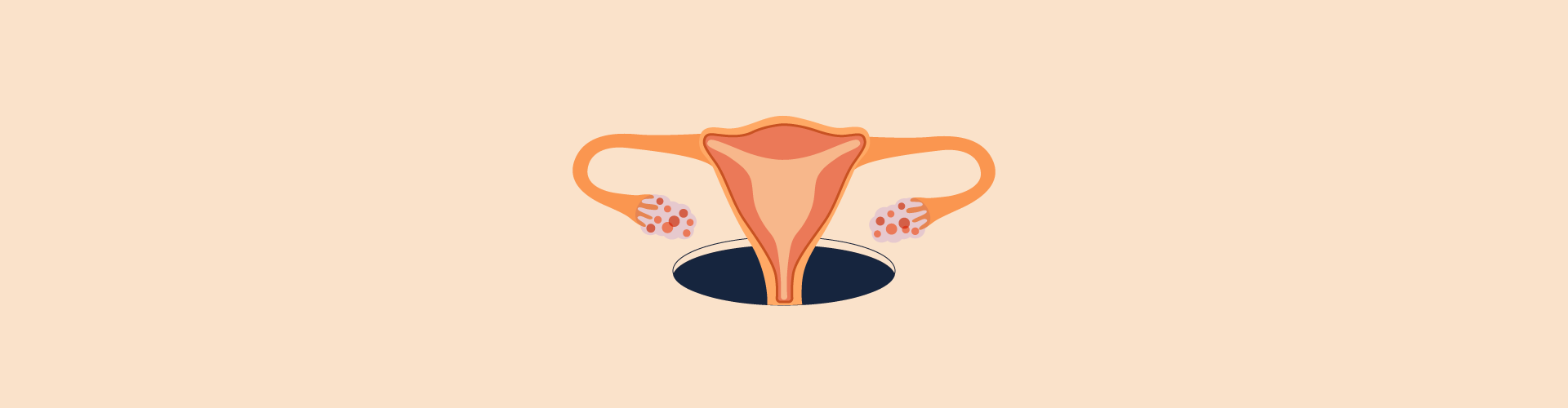 Polycystic ovary syndrome (PCOS)