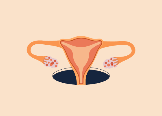  Polycystic ovary syndrome (PCOS)