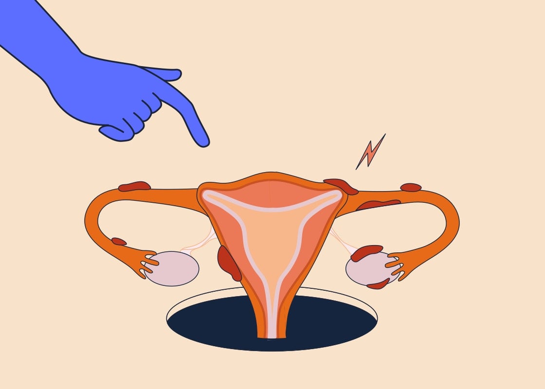  What is endometriosis and how does it affect fertility?